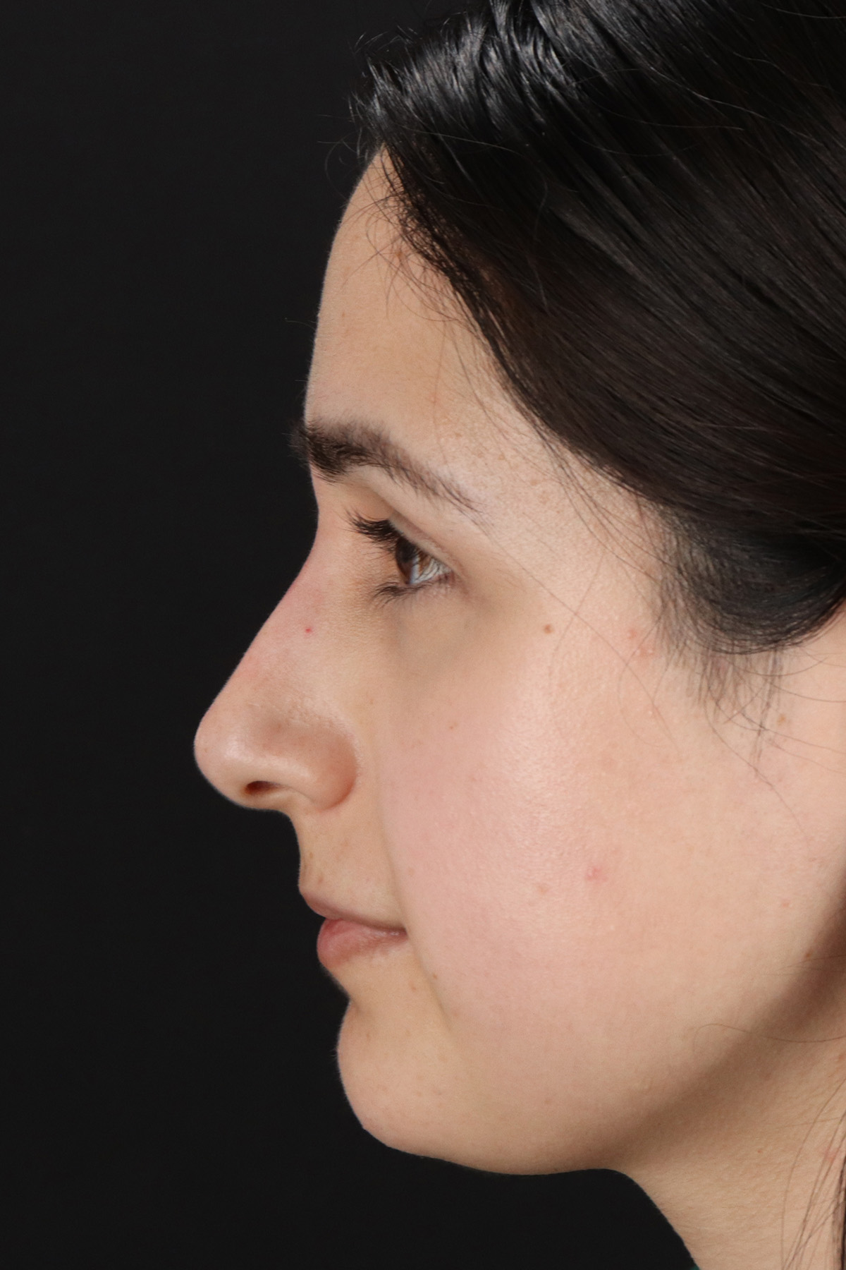 Liquid Rhinoplasty Before & After Patient #2188