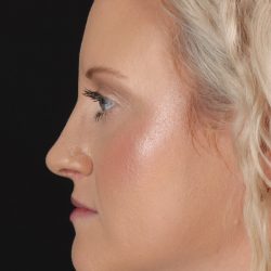 Rhinoplasty Before & After Patient #3126