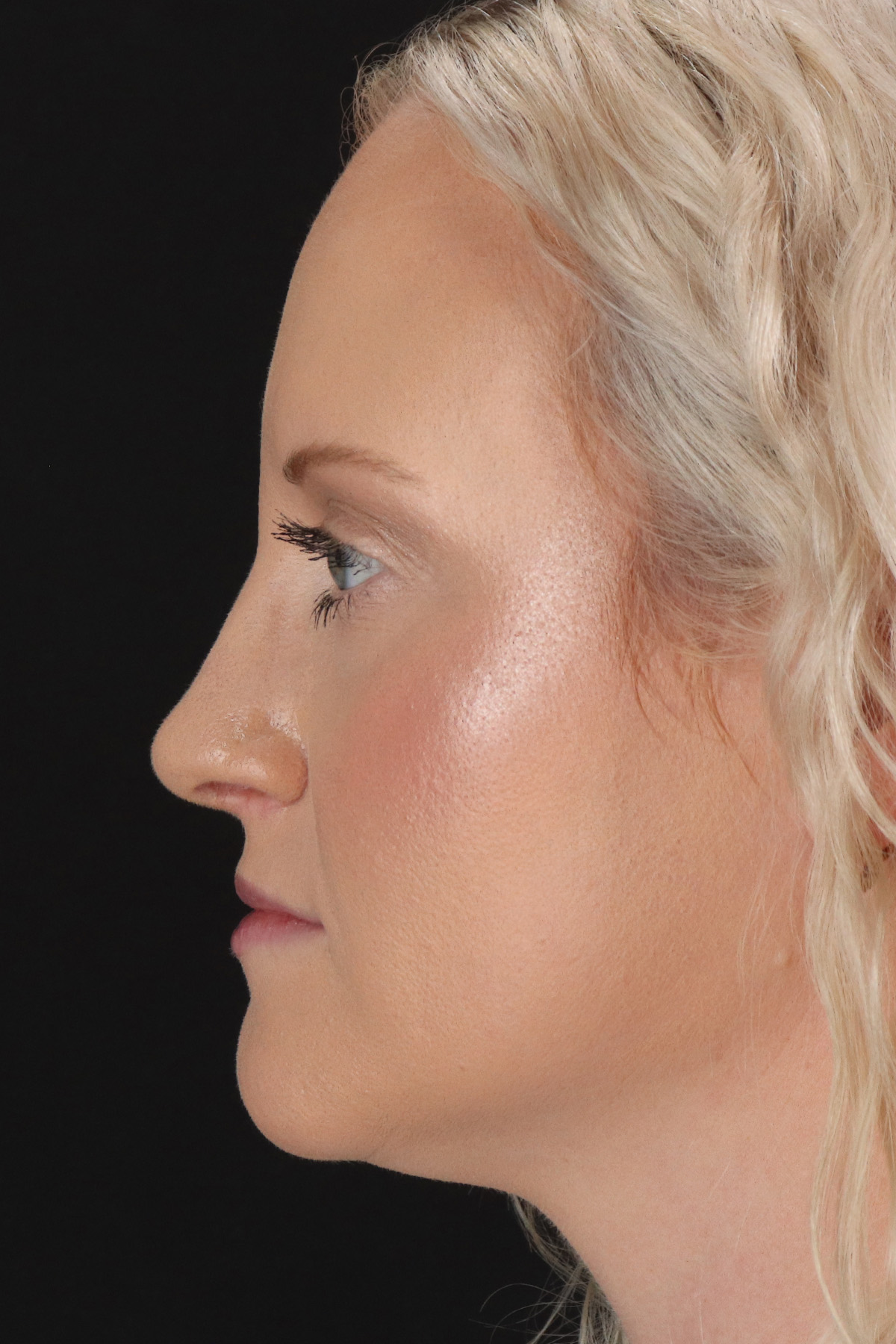 Rhinoplasty Before & After Patient #3126