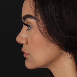 Rhinoplasty Before & After Patient #3192