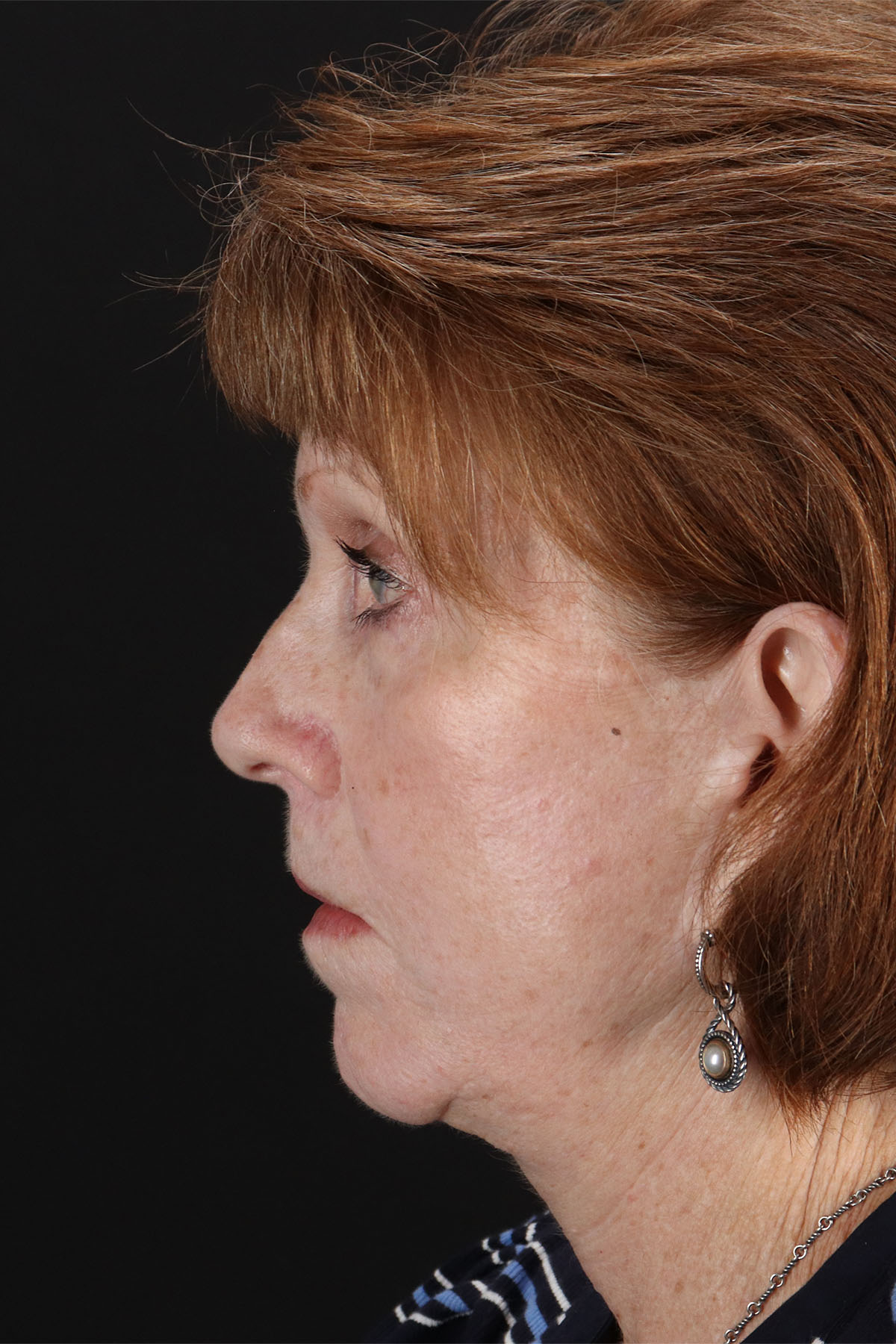 Lip Lift Before & After Patient #2155