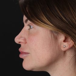 Rhinoplasty Before & After Patient #3093
