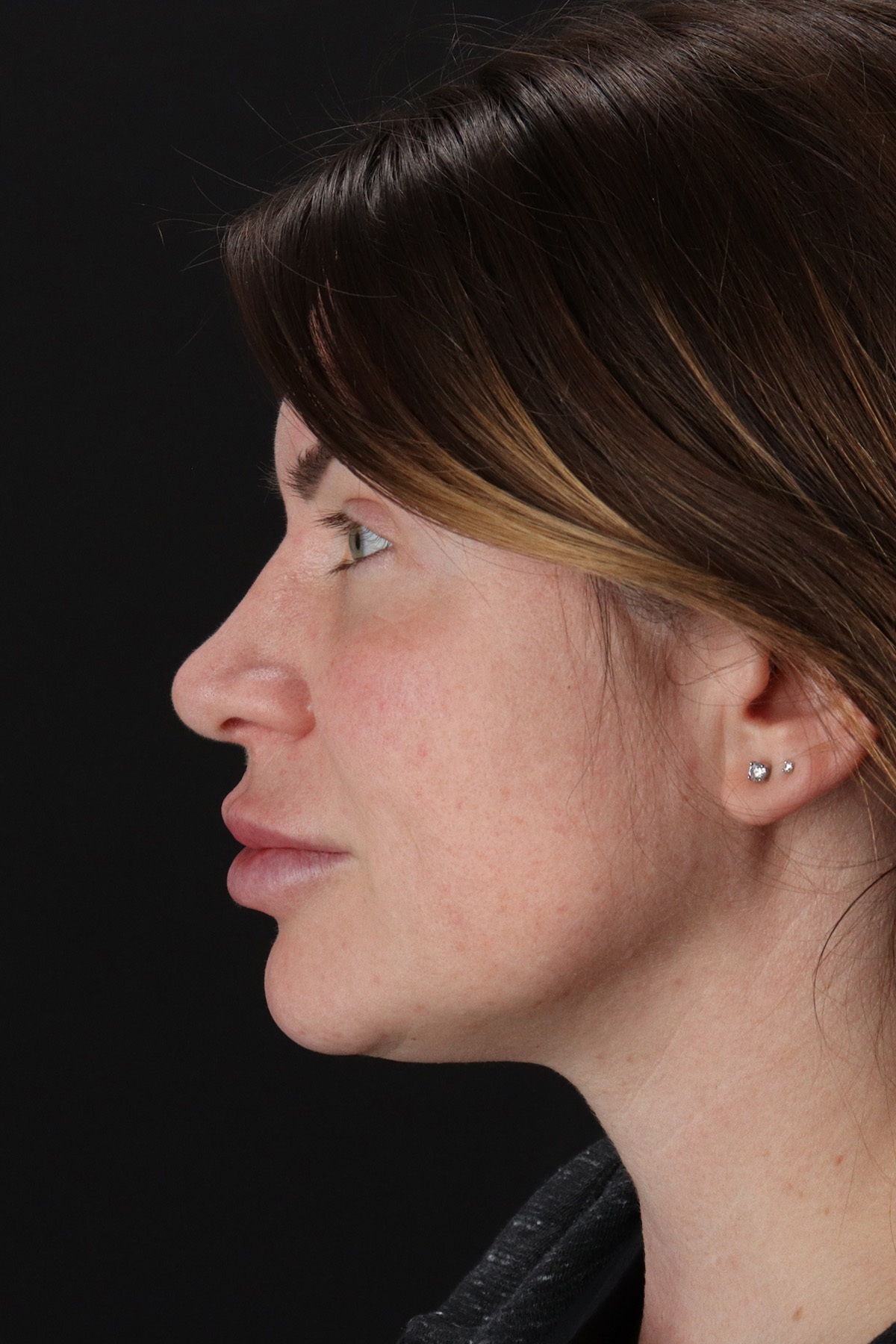 Rhinoplasty Before & After Patient #3093