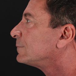 Facelift Before & After Patient #1899