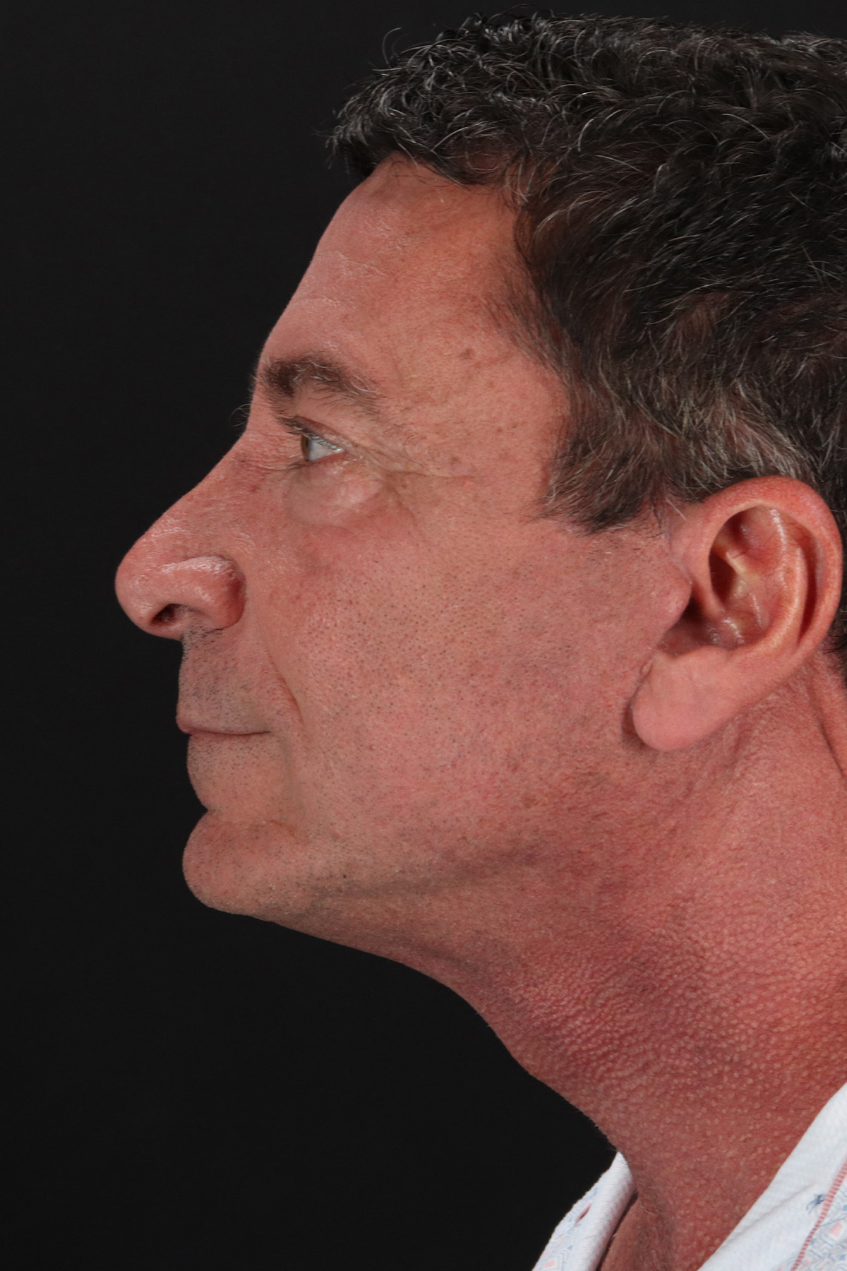 Facelift Before & After Patient #1899