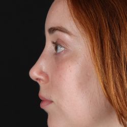 Rhinoplasty Before & After Patient #3170