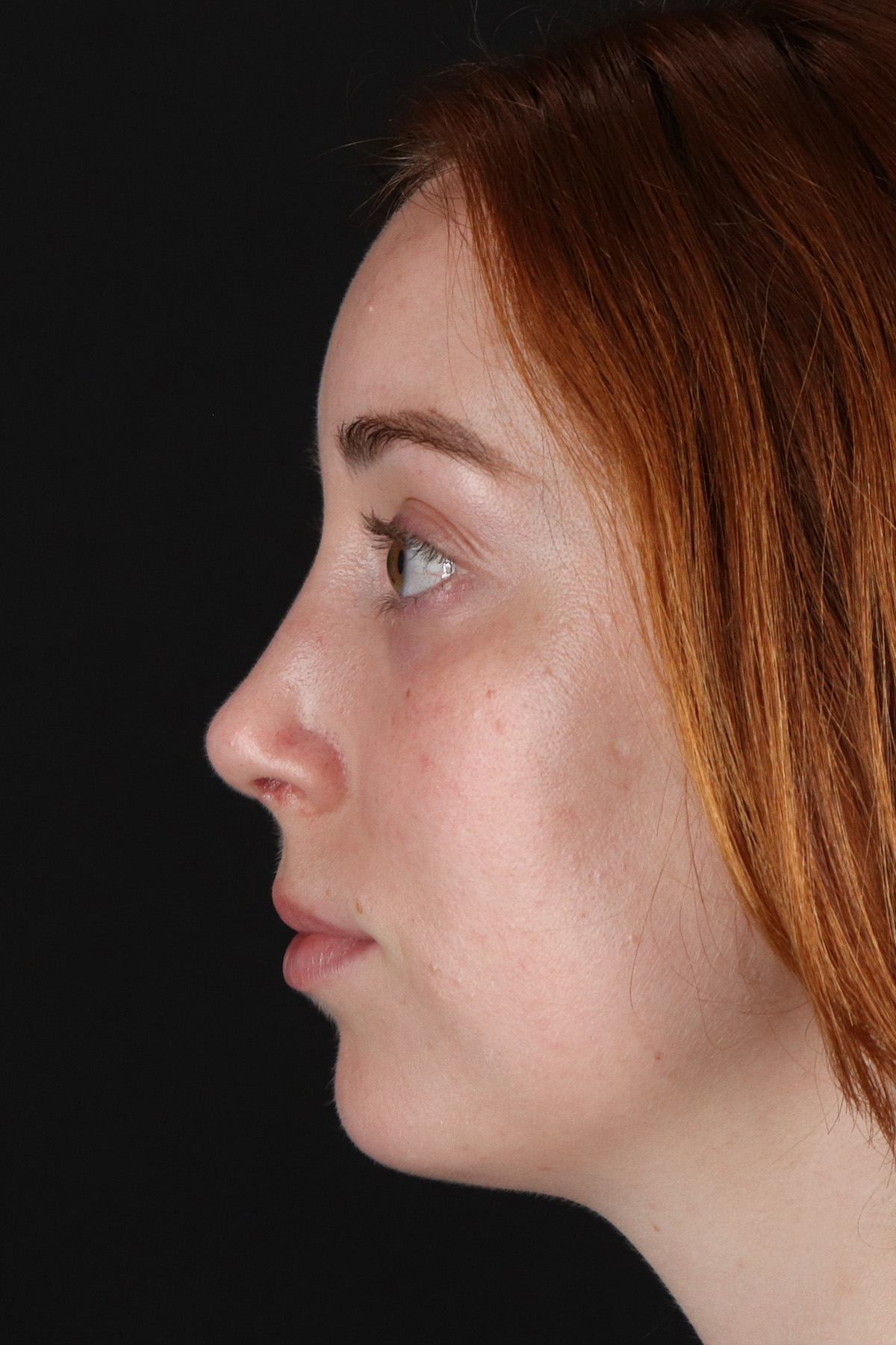Rhinoplasty Before & After Patient #3170