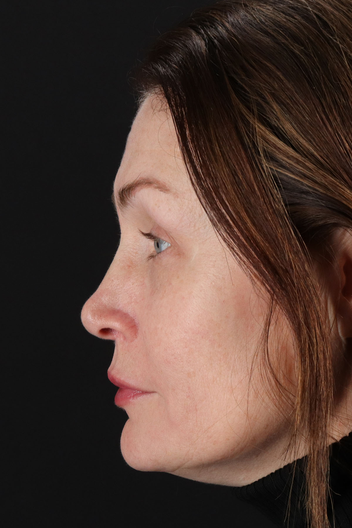 Lip Lift Before & After Patient #2144