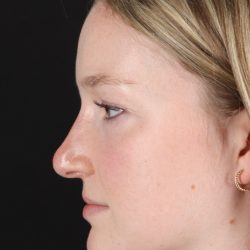 Liquid Rhinoplasty Before & After Patient #2177