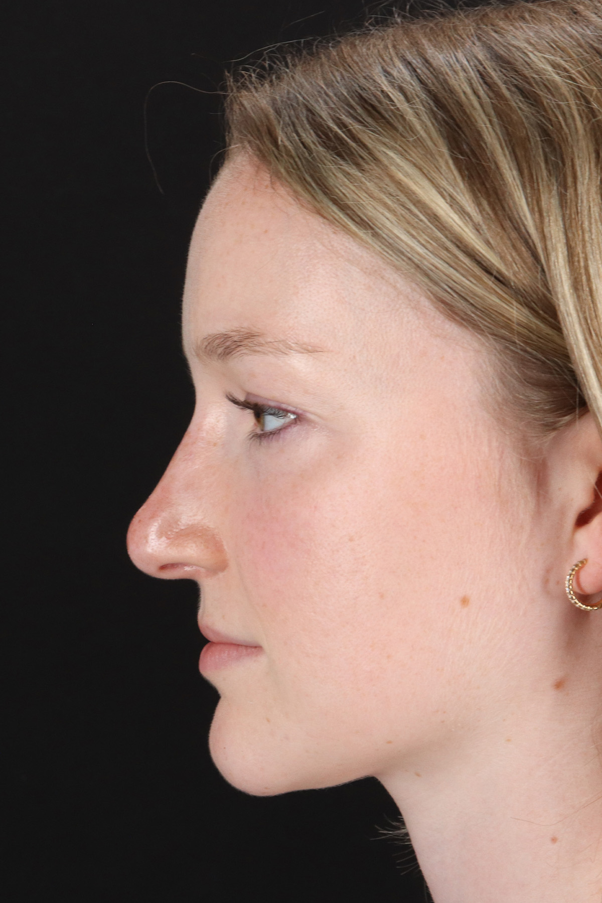Liquid Rhinoplasty Before & After Patient #2177