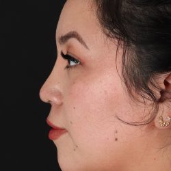 Rhinoplasty Before & After Patient #3060