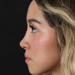 Rhinoplasty Before & After Patient #3302