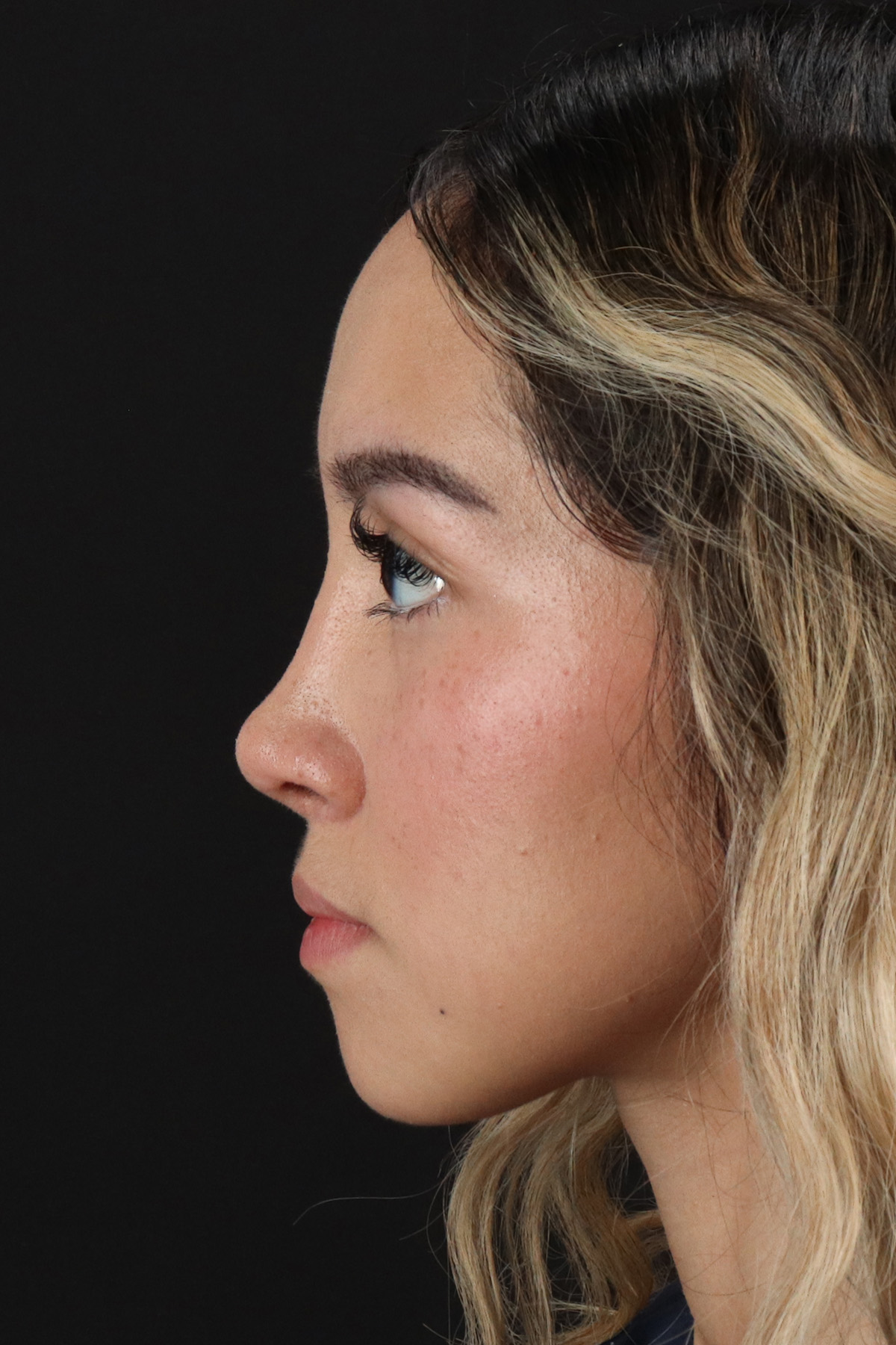 Rhinoplasty Before & After Patient #3302