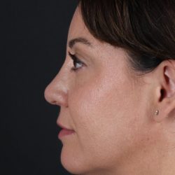 Browlift Before & After Patient #1363