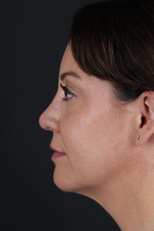 Browlift Before & After Patient #1363