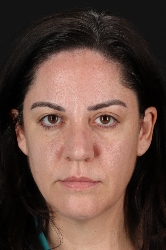 Browlift Before & After Patient #1363
