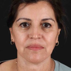 Facelift Before & After Patient #3544