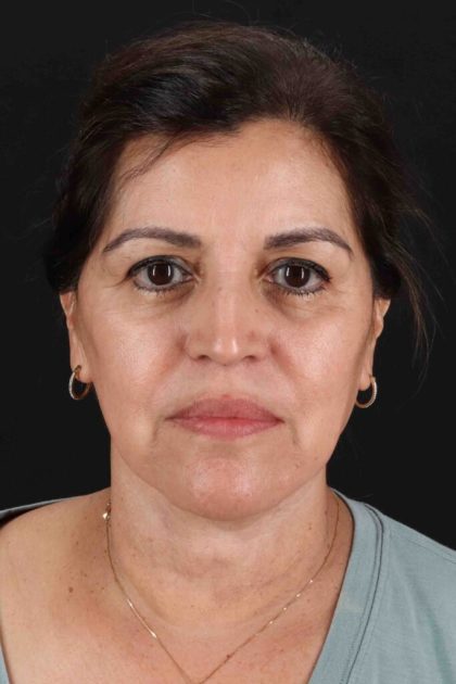 Facelift Before & After Patient #3544