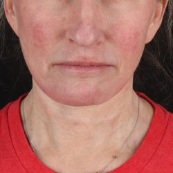 Neck Lift Before & After Patient #2571