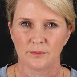 Facelift Before & After Patient #1877