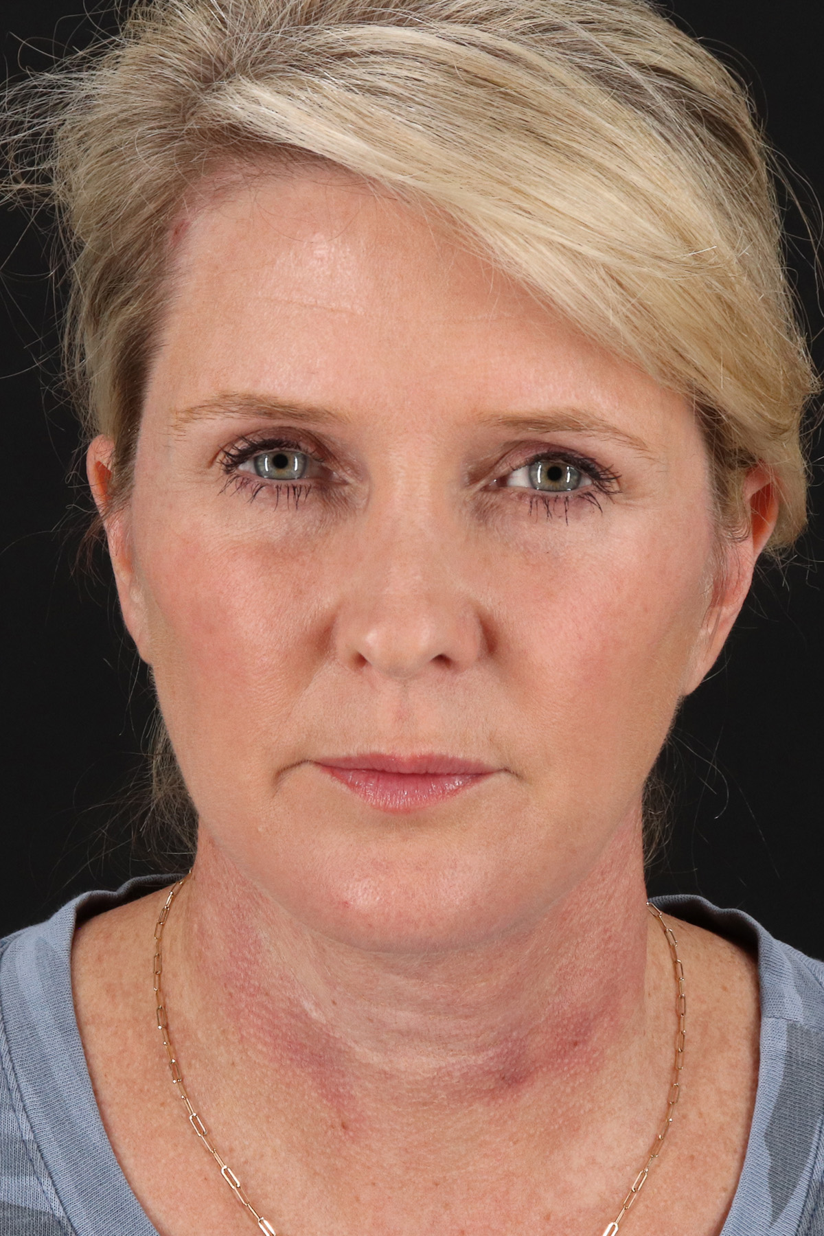 Facelift Before & After Patient #1877