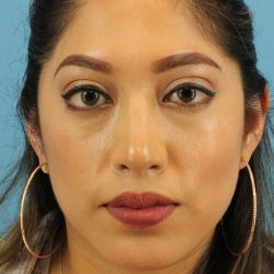 Chin Implant Before & After Patient #1670