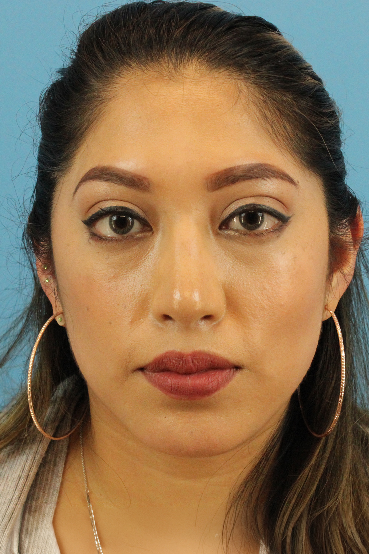 Chin Implant Before & After Patient #1670
