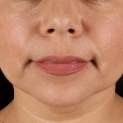 Facelift Before & After Patient #3555