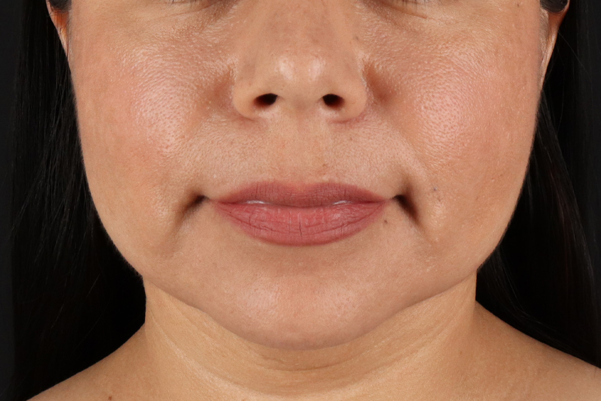 Facelift Before & After Patient #3555