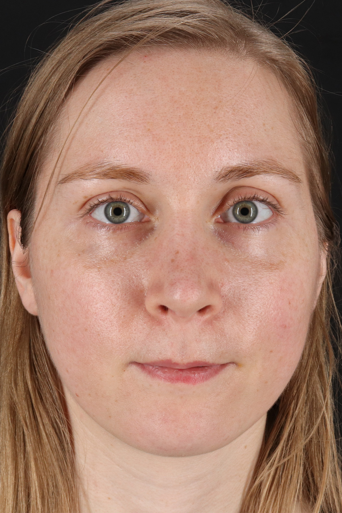 Rhinoplasty Before & After Patient #3280