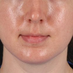 Chin Implant Before & After Patient #1562