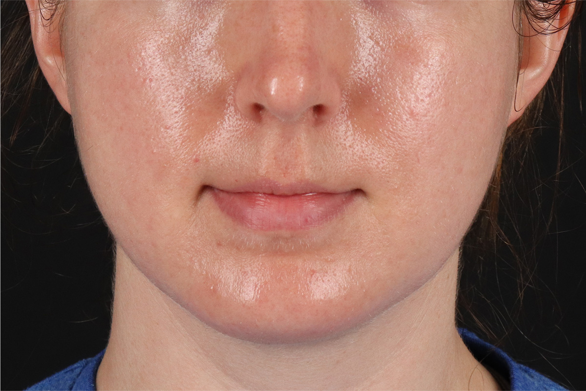 Chin Implant Before & After Patient #1562