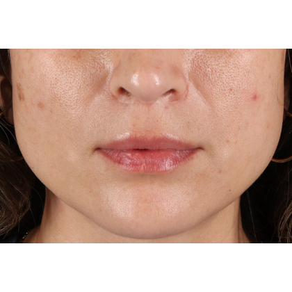 Lip Lift Before & After Patient #2166