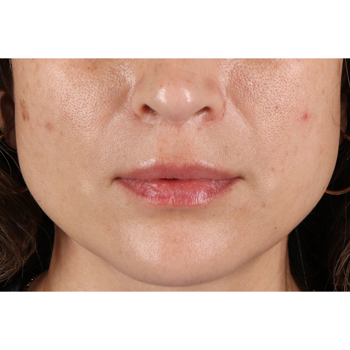 Lip Lift Before & After Patient #2166