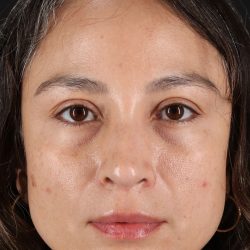 Lip Lift Before & After Patient #2166