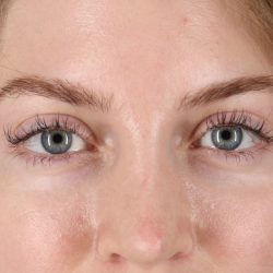 Browlift Before & After Patient #1319