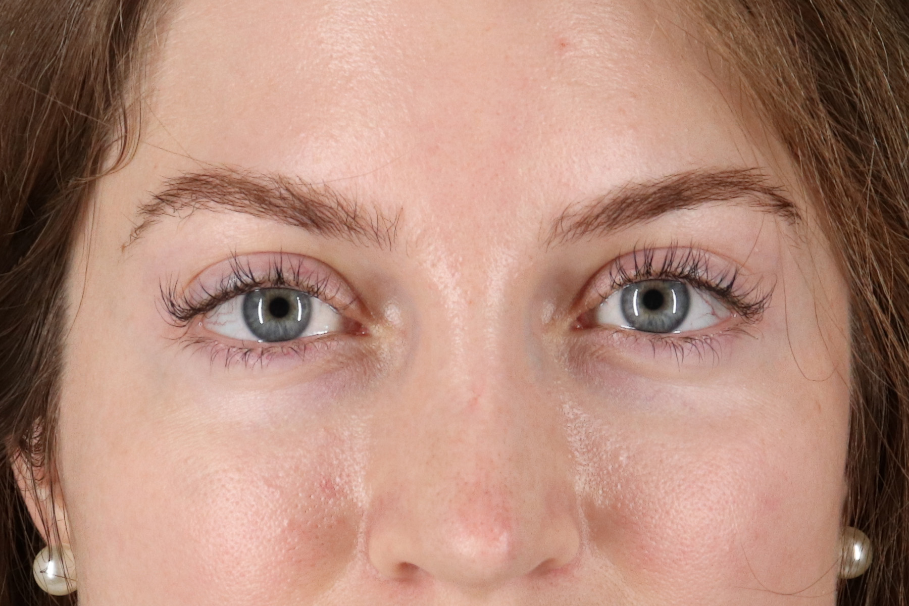 Browlift Before & After Patient #1319
