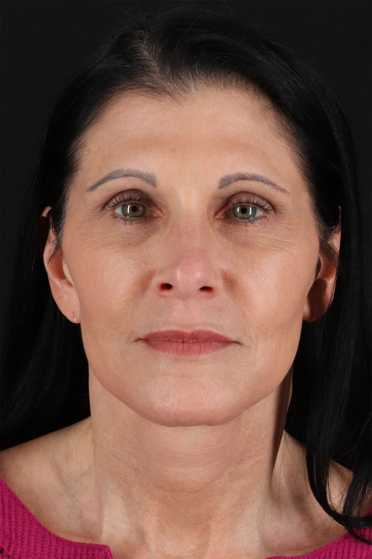 Fat Grafting To The Face Before & After Patient #2005