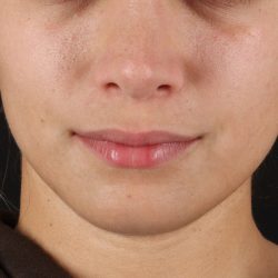 Chin Implant Before & After Patient #1573