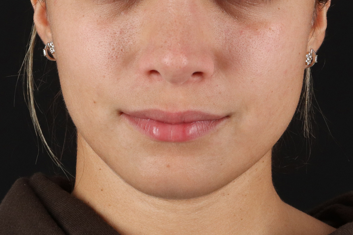 Chin Implant Before & After Patient #1573
