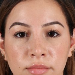 Rhinoplasty Before & After Patient #3247