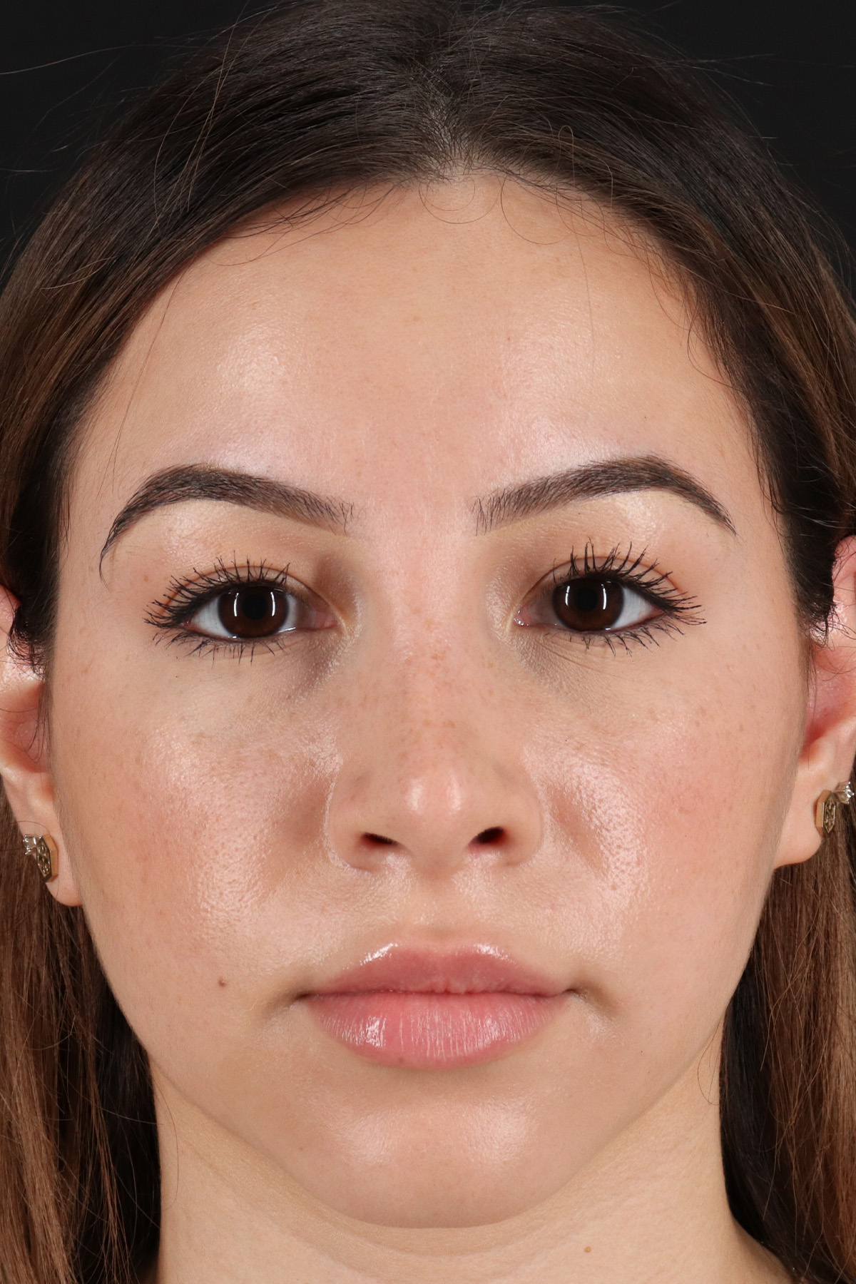 Rhinoplasty Before & After Patient #3247