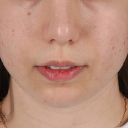 Chin Implant Before & After Patient #1551
