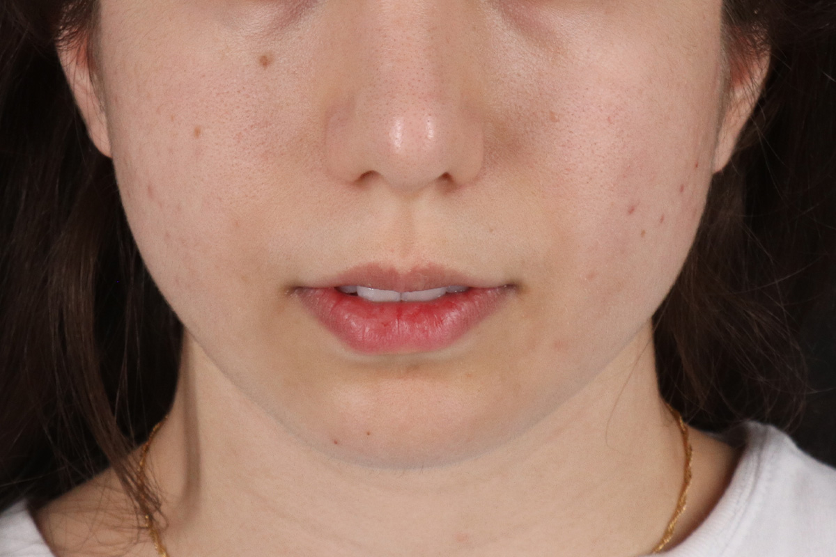 Chin Implant Before & After Patient #1551