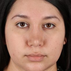 Chin Implant Before & After Patient #1604