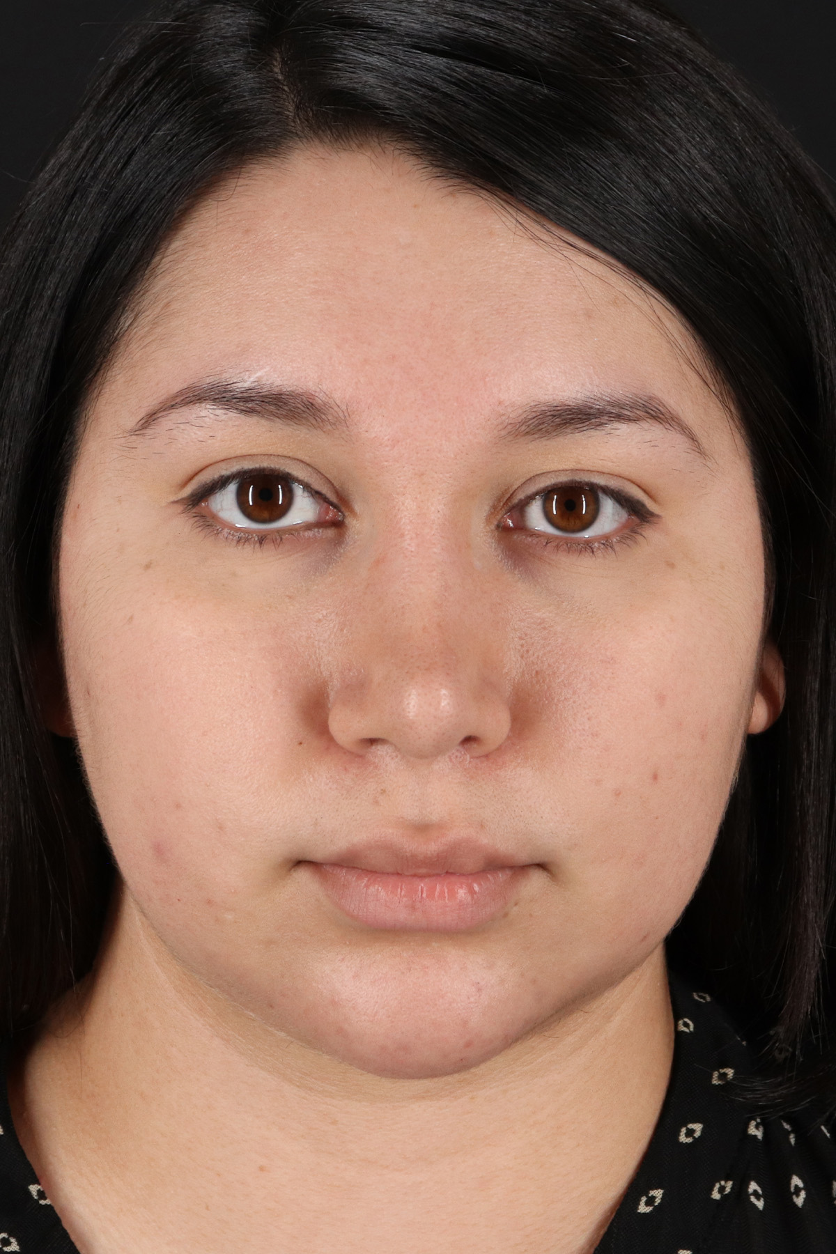 Chin Implant Before & After Patient #1604