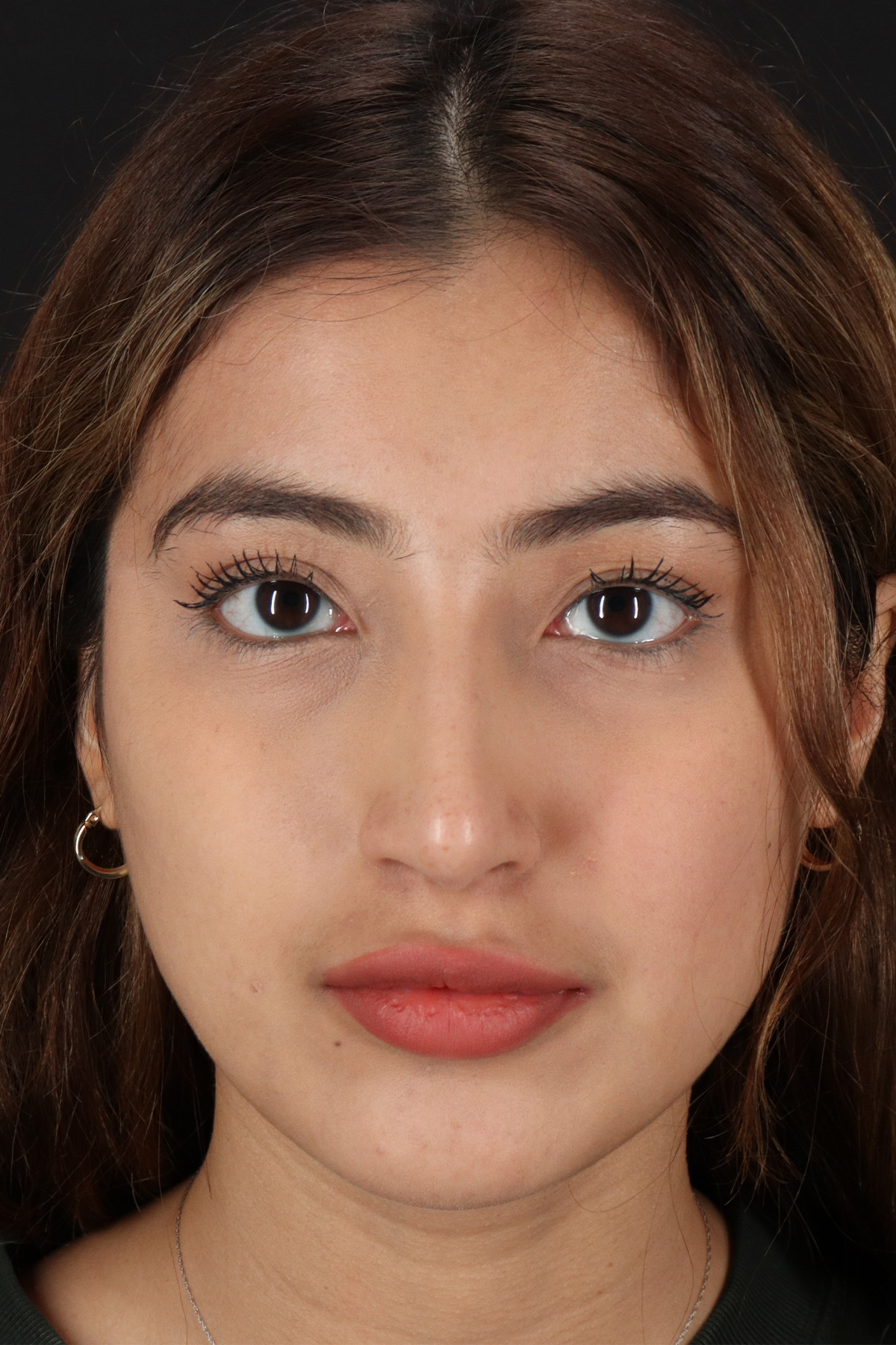 Liquid Rhinoplasty Before & After Patient #2254