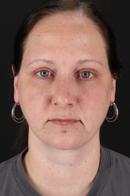 Facelift Before & After Patient #1843