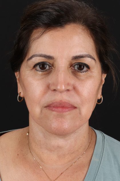 Facelift Before & After Patient #3544