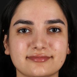 Rhinoplasty Before & After Patient #3071